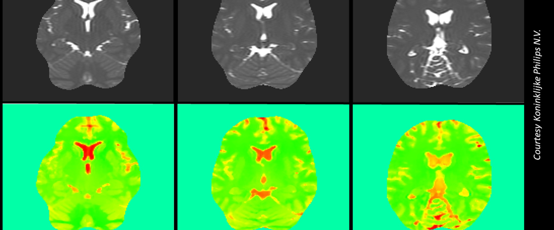 Six pictures showing a human brain scan. Three images in upper row showing black and white pictures of the brain and below these the corresponding EPT images in green with orange indicating tissue sub-types