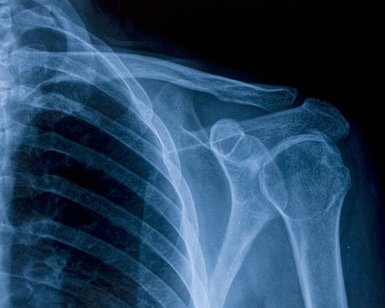 Image showing X-ray image of shoulder