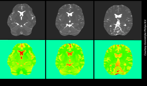 Six pictures showing a human brain scan. Three images in upper row showing black and white pictures of the brain and below these the corresponding EPT images in green with orange indicating tissue sub-types