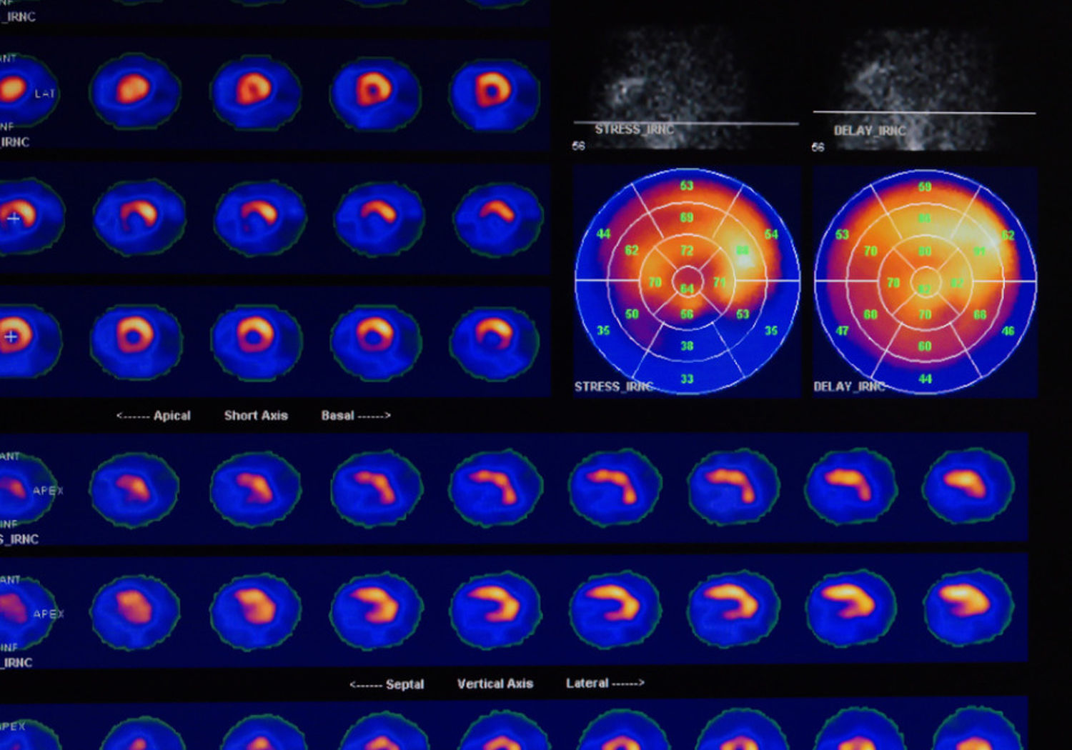 PET Image showing heart and coronary vessels 